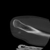 SPORK, NICO - 22.03.1976 - 02.08.2022 - CT obere Extremität - 17:59:38